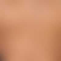 Amyloidosis macular cutaneous: Large, long-standing, continuously spreading, blurred, symmetrical...