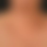 Amyloidose systemische vom Al-Typ. Nach banalen Anstrengungen oder lokalen Traumta völlig symptom...