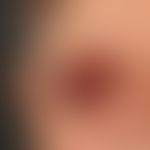 AL-Amyloidose bei Smoldering Myeloma. Bei dem 77jährigen Patienten bestehen, ohne ersichtlichen G...