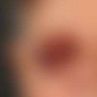 AL-Amyloidose bei Smoldering Myeloma. Bei dem 77jährigen Patienten bestehen, ohne ersichtlichen G...