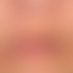 Exogene Ablagerungsdermatose: Argyrose
