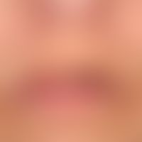 Exogene Ablagerungsdermatose: Argyrose
