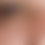 Xanthelasma. 63 Jahre alter Patient mit bekannter Hyperlipidämie. Die bestehende Hautläsion entwi...