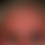 Skleromyxödem. Bei dem 62jährigen Patienten zeigt sich eine diffus verdickte und&nbsp;kräftig ger...