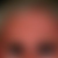 Skleromyxödem. Bei dem 62jährigen Patienten zeigt sich eine diffus verdickte und&nbsp;kräftig ger...