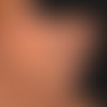 Argyrie: diffuse, graue bis graubräunliche, metallisch glänzende, diffuse Verfärbung der Gesichts...