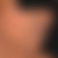 Argyrie: diffuse, graue bis graubräunliche, metallisch glänzende, diffuse Verfärbung der Gesichts...