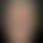 Argyrie: diffuse, graue bis grauschwärzliche, metallisch glänzende, diffuse Verfärbung der Gesich...