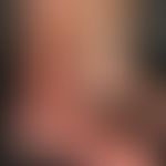 Acrodermatitis chronica atrophicans. clearly visible, flabby skin atrophy and edematous redness o...