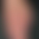 Acrodermatitis chronica atrophicans: extensive, oedematous, tender red erythema as well as flacci...