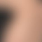 Artefakte. Multiple, runde, "ekzematöse" flache, scharf begrenzte&nbsp;Ulzerationen bei einer ans...