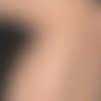 Artefakte. Multiple, runde, "ekzematöse" flache, scharf begrenzte&nbsp;Ulzerationen bei einer ans...