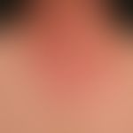 Airborne Contact Dermatitis: Subakute, unscharf begrenzte, rote&nbsp;Plaque. Hier der Übergang zu...