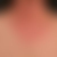Airborne Contact Dermatitis: Subacute, blurred, red plaque, here the transition to the non-free s...
