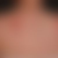 Angry back: Multiple "false positive" and clinically irrelevant test reactions in epicutaneous te...