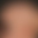 Alopecia areata totalis:&nbsp;kompletter Haarverlust an Capillitium und Augenbrauen. Eingekreist ...