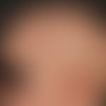Alopecia areata totalis:complete loss of hair on the capillitium and eyebrows, encircling an area...