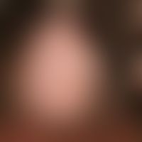 Alopecia areata: große haarlose Fläche mit erhaltener Follkelstruktur.
