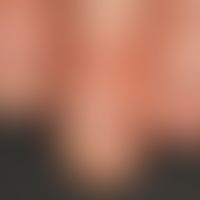 Alopecia areata: Diffuse, rough keratinization disorders of the nails (trachyonychia) in Alopecia...