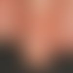 Alopecia areata: Diffuse, rough keratinization disorders of the nails (trachyonycie) in Alopecia ...