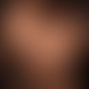 Alopecia areata:&nbsp;rundliche, sich zentrifugal und medial ausbreitende, glatte, hautfarbene, h...