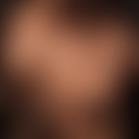 alopecia areata. roundish, centrifugally and medially spreading, smooth, skin-coloured, hairless ...