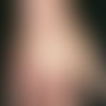 Acrocyanosis: Diffuse, reddish-livid skin discolouration at reduced temperature and doughy swelli...