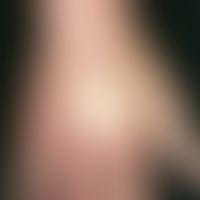 Acrocyanosis: Diffuse, reddish-livid skin discolouration at reduced temperature and doughy swelli...