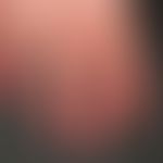 Acrocyanosis in age-atrophied, shiny skin, alternating temperature-dependent colouring from mediu...