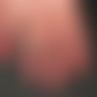 Acrocyanosis in age-atrophied, shiny skin, alternating temperature-dependent colouring from mediu...