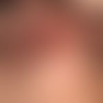 Acne keloidalis nuchae: multiple, solitary or confluent, follicular light red papules, pustules a...