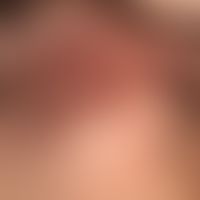 Acne keloidalis nuchae: multiple, solitary or confluent, follicular light red papules, pustules a...