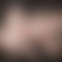 Folliculitis decalvans. scarring hair loss that has been progressing for several years, with itch...