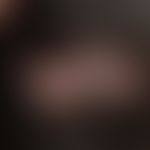 Folliculitis decalvans. 24 months of persistent scarring hair loss, with initially slight itching...