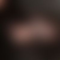 Folliculitis decalvans. 24 months of persistent scarring hair loss, with initially slight itching...