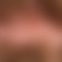 Folliculitits decalvans: Close-up with shiny atrophy of the scalp and tufts of hair; the keatotic...