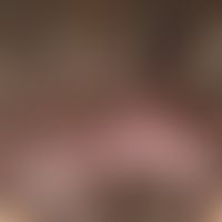 Folliculitits decalvans: Scarring alopecia with shiny hairless area and tufts of hair at the edges.
