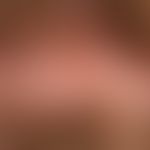 Büschelhaare:&nbsp;Folliculitis decalvans. Spiegelnde Narbenplatte mit randständigen dochtartigen...