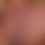Angiokeratoma scroti et vulvae. chronically stationary, multiple, bluish to dark black, 0.2-0.5 c...