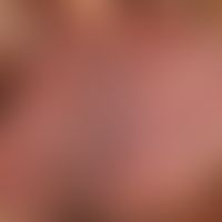Angiokeratoma scroti et vulvae. Chronisch stationäre, multiple, bläulich bis dunkelschwarze, 0,2-...
