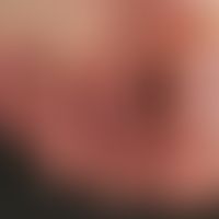 Anonychia in epidermolysis bullosa dystrophica Hallopeau-Siemens
