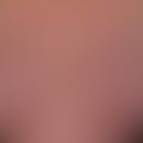 Steroid atrophy of the skin. Long-term internal and local (steroid spray for bronchial asthma) th...