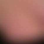 Striae cutis distensae: Langjährige interne und lokale (Steroidspray wegen Asthma bronchiale) The...