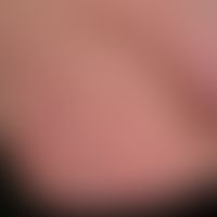 Striae cutis distensae: Long-term internal and local (steroid spray for bronchial asthma) therapy...