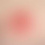 Drug reaction, fixed (detail). two red, sharply defined, moderately itchy plaques, existing for a...