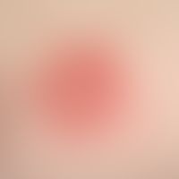 Drug reaction, fixed (detail). two red, sharply defined, moderately itchy plaques, existing for a...
