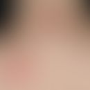 Arzneimittelreaktion, fixe: zwei&nbsp;seit&nbsp;wenigen Tagen bestehende, rote, scharf begrenzte,...