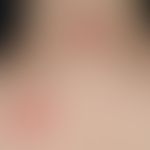 Drug reaction, fixed: two red, sharply defined, moderately itchy plaques that have existed for a ...