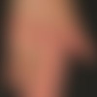 Dermatomyositis. Gottron-Papeln bei einer 72-jährigen Frau. Es zeigen sich kleinere, streifig ang...