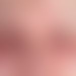 Dermatomyositis. Akut aufgetretene Lidödeme, mit&nbsp; unscharf begrenzten symmetrischen &nbsp;Ey...